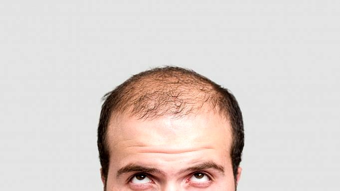 Ja, Haarausfall Ist Genetisch Bedingt